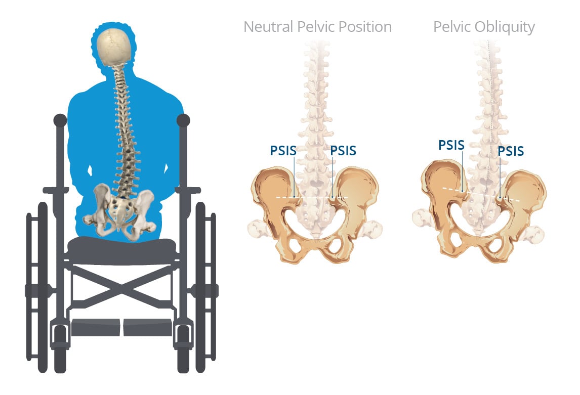 Pelvic Obliquity Definition, Symptoms and Solutions